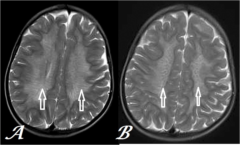 metachromatic leukodystrophy