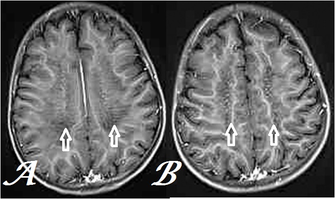 metachromatic leukodystrophy