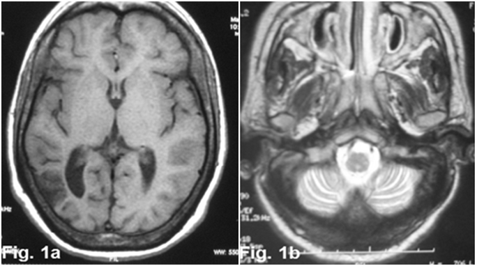 Anesthetic consideration of Niemann-Pick Disease type C