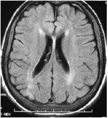 Niemann-Pick disease type C-presenting as persistent neonatal jaundice: a  rare case report