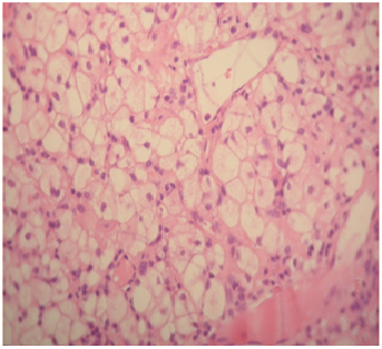 Bone marrow involvement in Niemann Pick disease - 1.