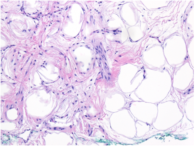 spindle cells and ropey collagen- found in spindle cell lipomas