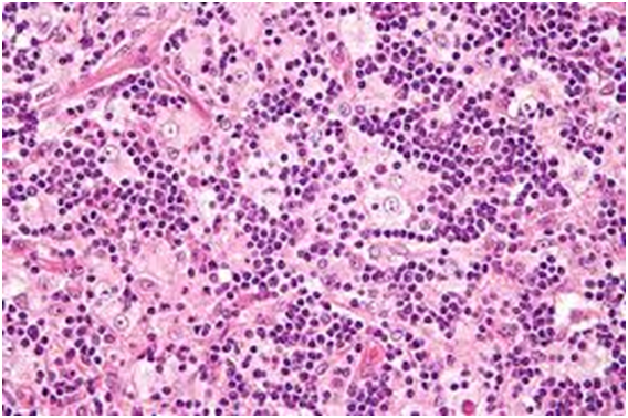 Phagocytosis And Emperipolesis Rosai Dorfmans Syndrome