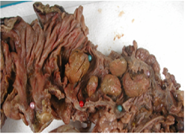 Stercoral Perforation of the Sigmoid Colon: A Case Report