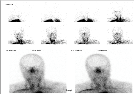 Brain Death Scintigraphy using Tc-99m DTPA: Does Equivocal Cerebral ...